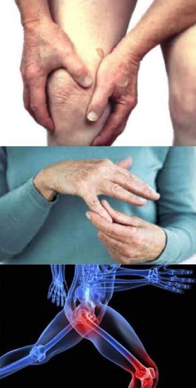 1. derece osteoartrit deformitesi